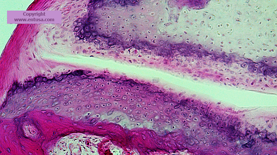 Microscopic view of the incudostapedial joint.  The lenticular process of the incus is superior, the head of the stapes is inferior